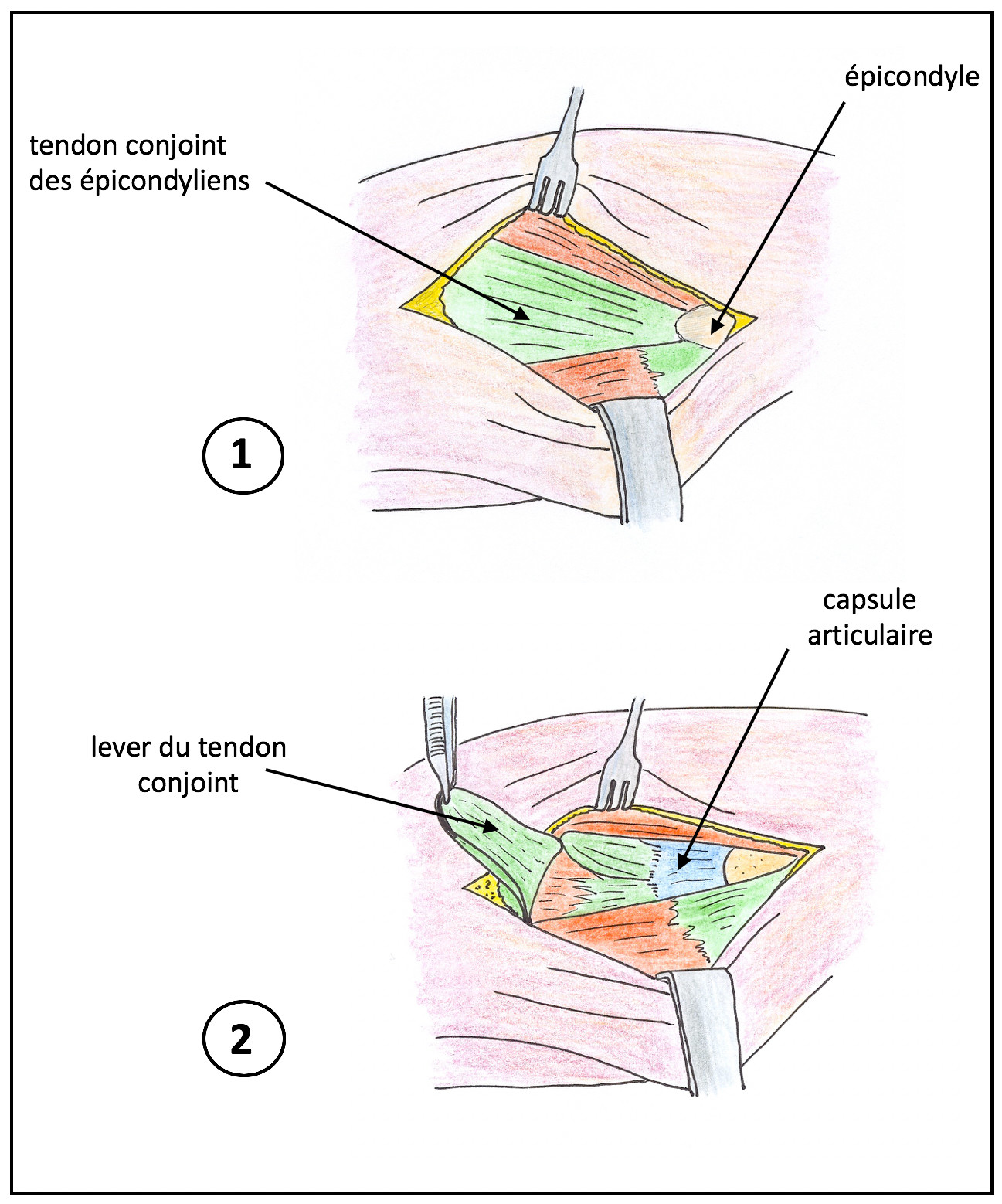 Chirurgie des épicondylites (1)