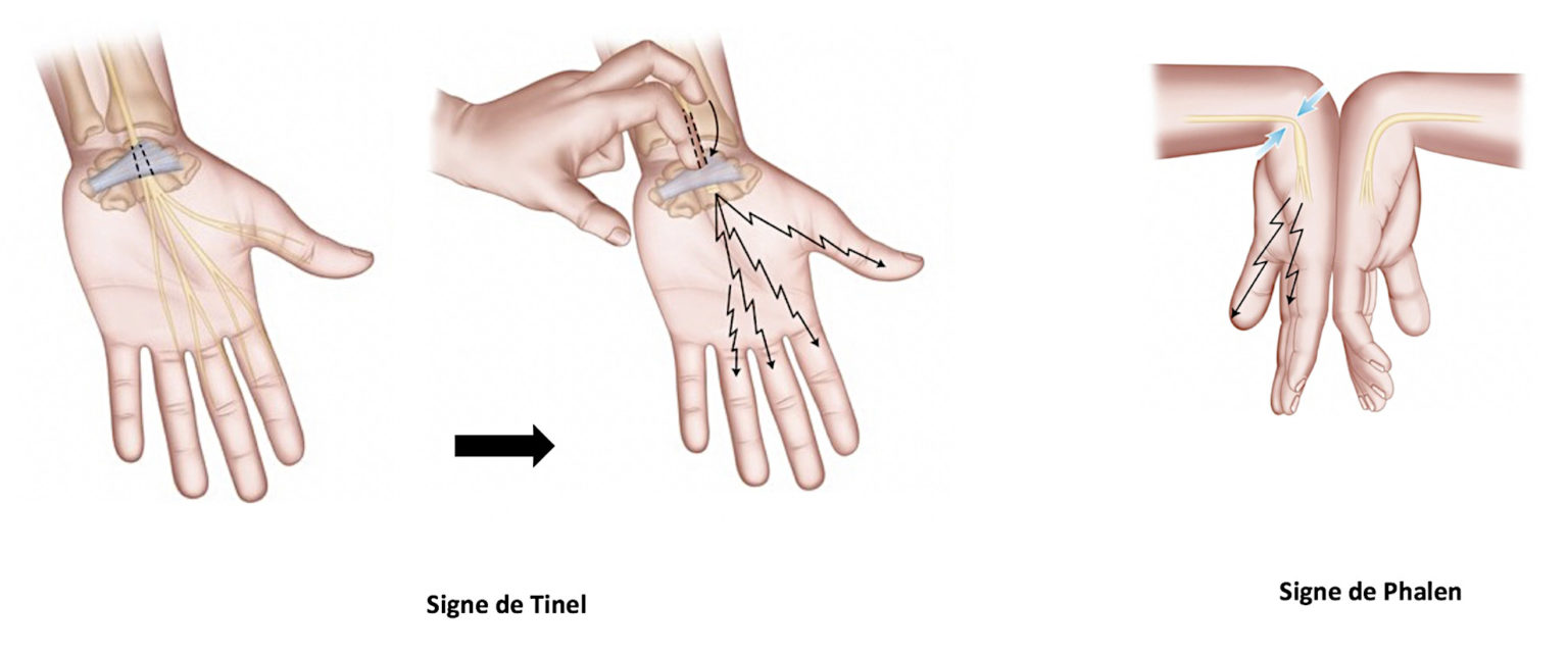 Le syndrome du canal carpien, Centre du Membre Supérieur Trénel, Vienne