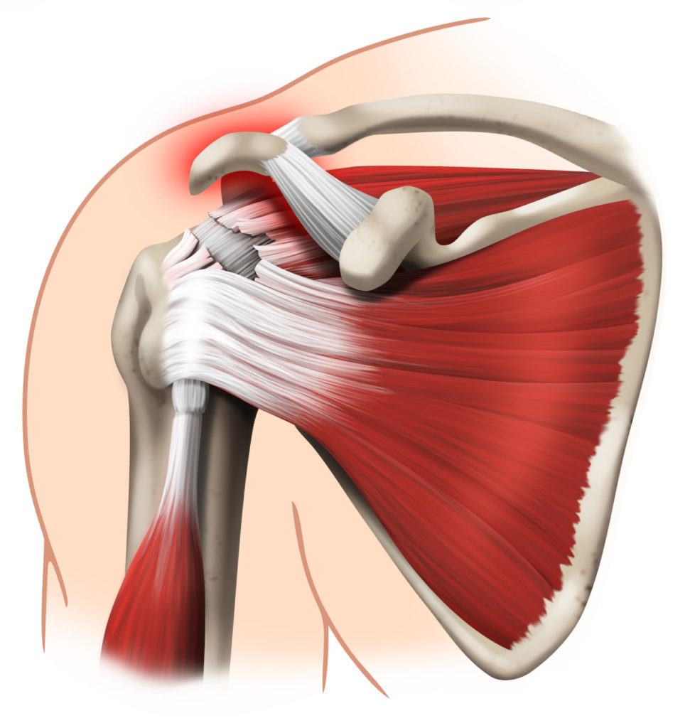 Разрыв лопатки. Ротаторная манжета плечевого сустава сухожилия. Повреждение ротаторная манжета. Вращательная манжета плечевого сустава мышцы. Ротаторная манжета плечевого разрыв.