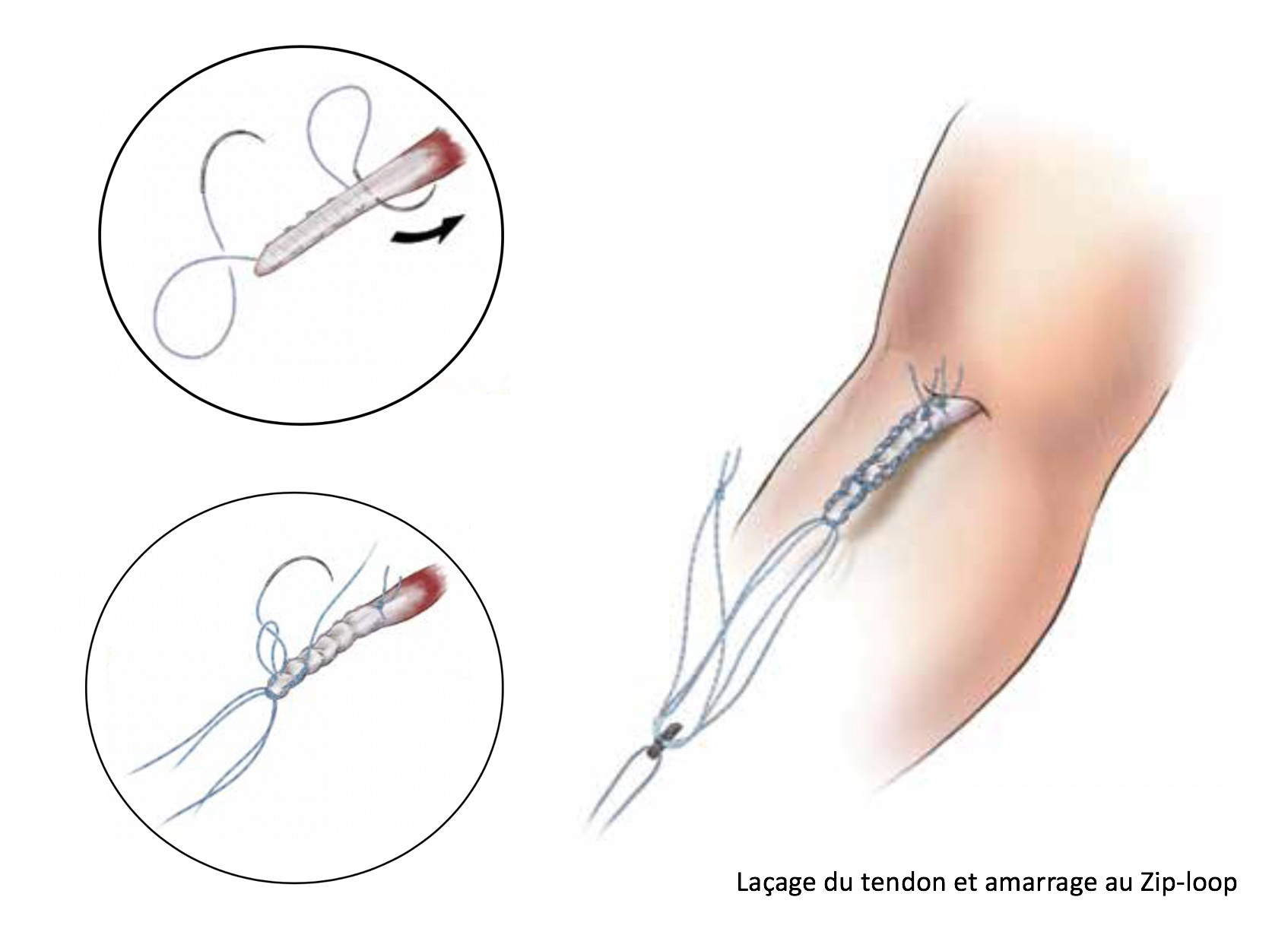 Principe du laçage du tendon bicipital