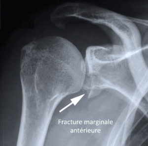 Fracture marginale antérieure